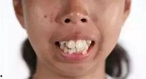 明星龅牙矫正,蜕变背后的坚持与勇气